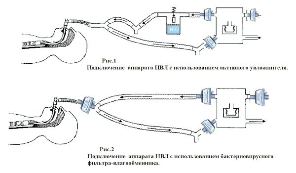 Схема подключения аппарата ИВЛ Схема подключения аппарата ИВЛ